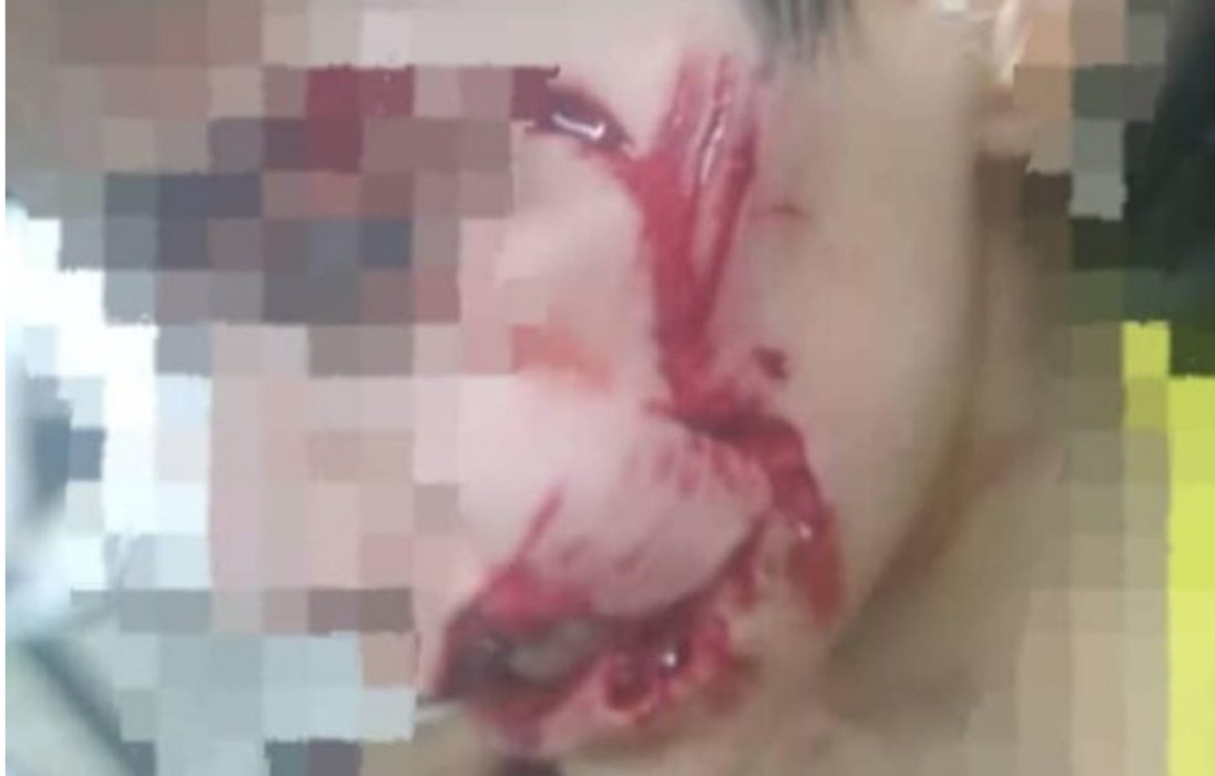 مرگ دردناک کودک ۹ ساله مسجدسلیمانی پس از حمله سگ‌های ولگرد / فریاد خاموش یک بی‌گناه