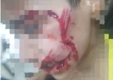 مرگ دردناک کودک ۹ ساله مسجدسلیمانی پس از حمله سگ‌های ولگرد / فریاد خاموش یک بی‌گناه